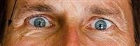Visual Changes AFTER Cataract Surgery