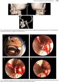 Transoral endoscopic-assisted
