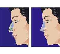 جراحة الأنف التجميلية