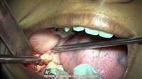 Wisdom Tooth Extraction