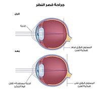 Eye laser operations