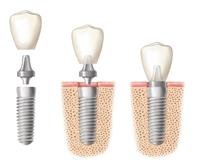 What are dental implants