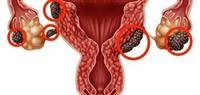 Endometriosis disease,