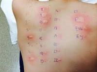 What to Do if You Suspect a Food Allergy