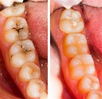 WHAT IS DENTAL FILLING?