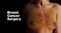 Breast Cancer Surgery Directory