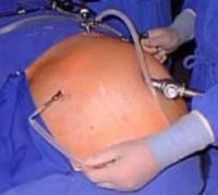 The first Saudi surgeon to perform laparoscopic