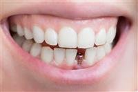 Everything You Need to Know About Dental Implants