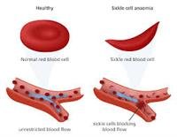 Sickle Cell  Disease