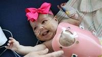 Baby Born With Heart Outside Body Leaves Texas Hos