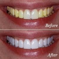 Whiten Teeth at Home or in the Dentist's Office?