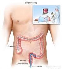 After Anal and Rectal Surgery