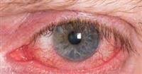 Uveitis,,