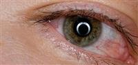 conjunctivitis