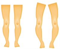 Rotational and angular deformities in the legs