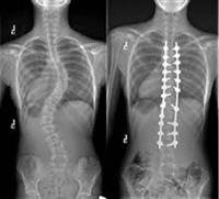 Scoliosis - Surgery
