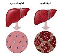 مرض تليف الكبد