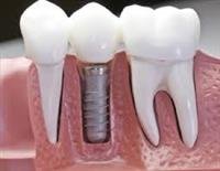 Bridging the Gap With  Dental Implants