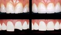 Repairing a Chipped or  Broken  Tooth