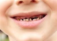 Dental Health and Cavities