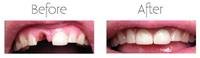Root  Canal Treatment