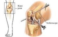 Arthroscopic Knee Surgery and Older Patients