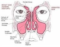 Endoscopic  Surgery for Sinusitis