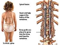 Spinal Fusion Surgery