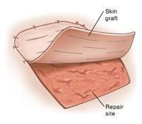 Skin Graft