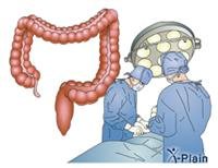 Colorectal Cancer Surgery