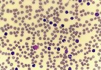 Chronic Lymphocytic