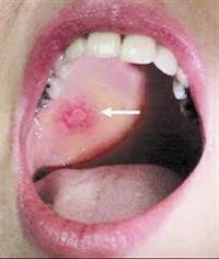 8 percent of tumors affect "the mouth and tongue"