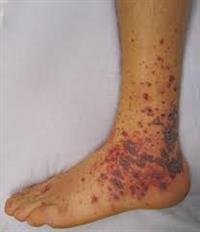Microscopic Polyangiitis ..