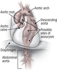 Shining a light on thoracic aortic disease
