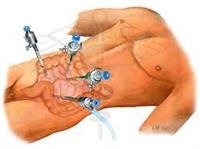 Visual  Changes AFTER Cataract Surgery