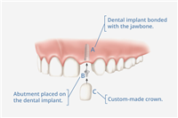 Dental Implants and their Advantages