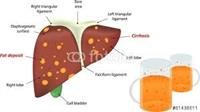 Alcohol-related liver disease