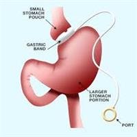Adjustable  Gastric  Banding Surgery