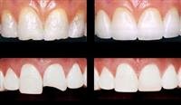 Chipped Or Broken Tooth
