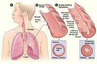 Lung  Diseases  Overview