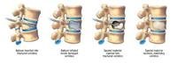 Vertebroplasty for Spine Fracture Pain