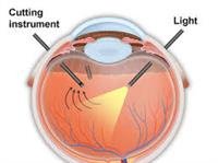 Vitrectomy