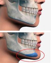 Deciding  to Get  a Facial Implant