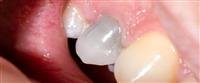 Dental nerve death: important information<<