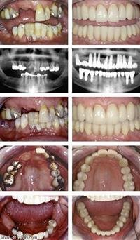 Dental implants.