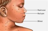 Chickenpox (Varicella) - Home Treatment