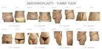 Tummy Tuck (Abdominoplasty)