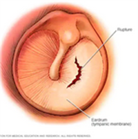 ruptured eardrum (perforated eardrum).