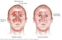 An Overview Of Sinusitis