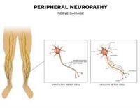 Neuropathy, Peripheral